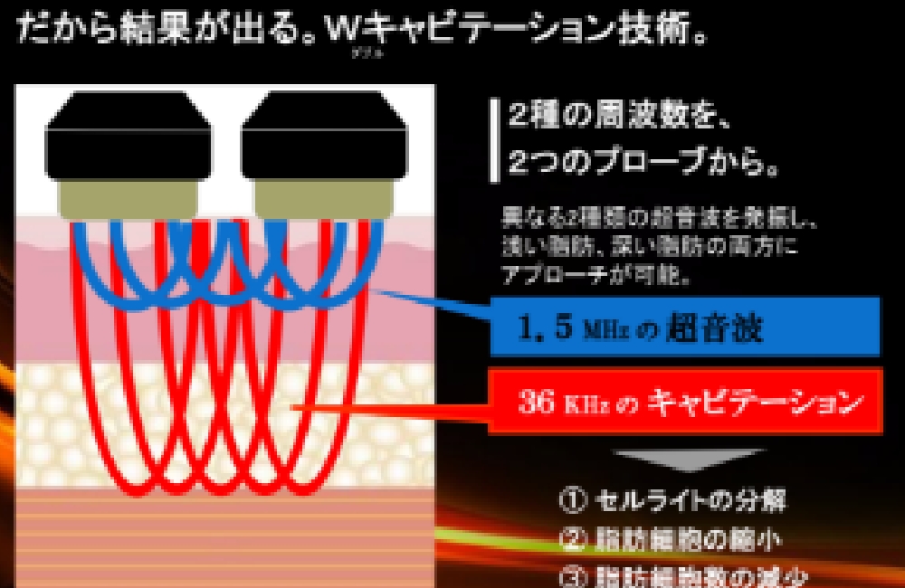 Wキャビテーション技術